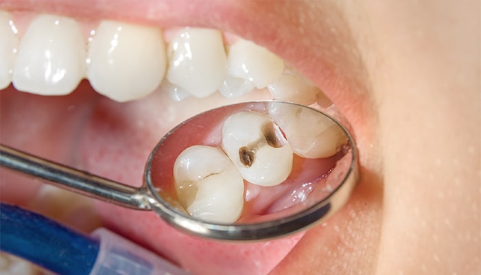 虫歯治療後の修復