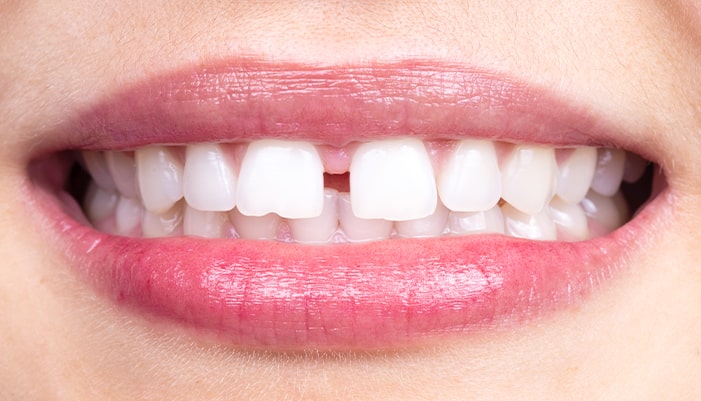 すきっ歯などの改善