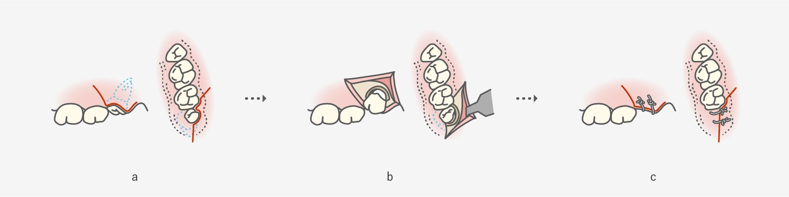 粘膜を切開すれば、骨を削らなくても抜歯出来る症例